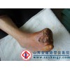 動脈硬化閉塞癥治療上益康脈管炎醫(yī)院，閉塞性動脈硬化